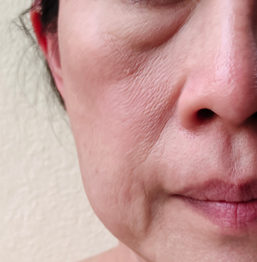 Da ù lì không chuyển hóa, mất mật độ da